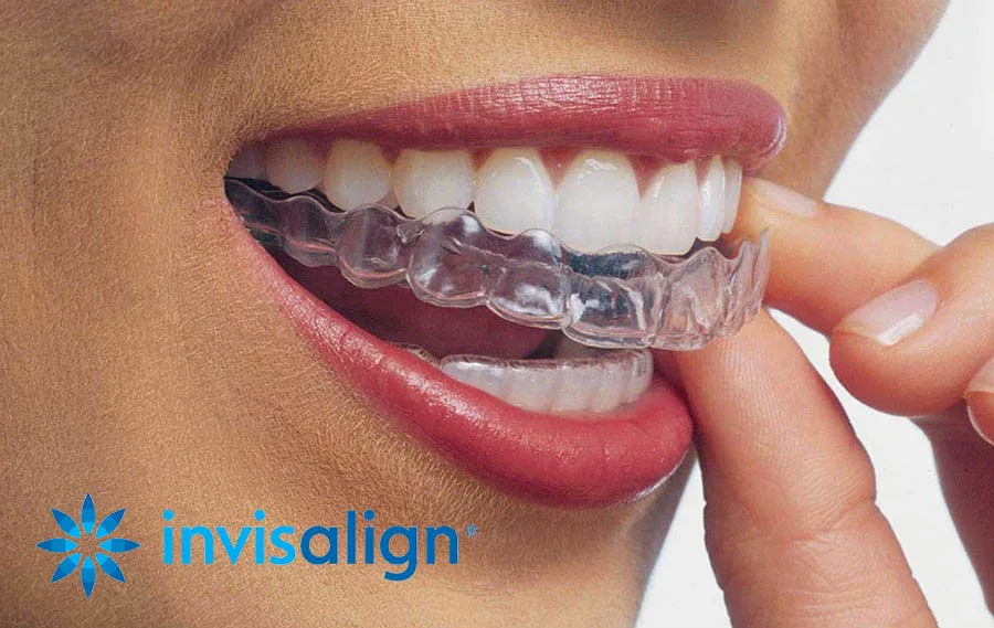 Invisalign: ortodoncia invisible y planificación digital